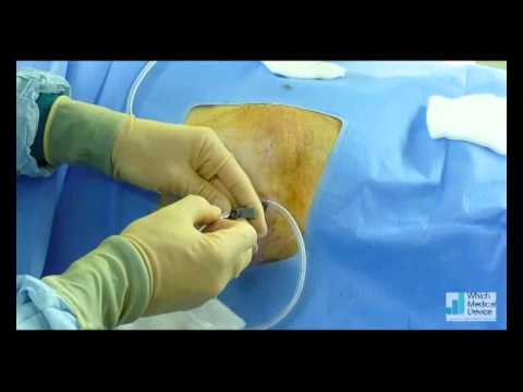Pleurx - This video shows the technique for insertion of a pleurx drain. This is a very simple interventional radiology procedure that is performed under local anaest...