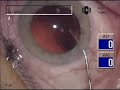 Hydro Polishing of Capsule