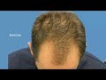 Hair Transplant After Video - 4200 Grafts - Doctor Hasson Hair Transplant After Video - 4200 Grafts - Doctor Hasson