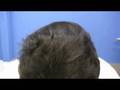 Hair Transplant Surgery by Dr Hasson - 4200 Grafts - Doctor Hasson