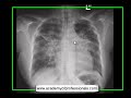 Chest x-ray, Pneumocystis carinii pneumonia, lamellar effusion