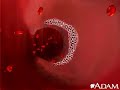 Atherosclerosis