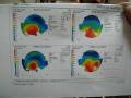 videos de CORNEAL TOPOGRAPHY EXPLAINED