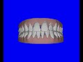 Clin Check Invisalign Clin Check Invisalign