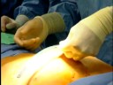 Groundbreaking surgery for pectus carinatum at CHKD
