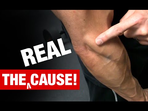 how to treat tennis elbow