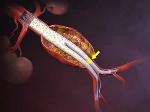 how to repair aortic aneurysm