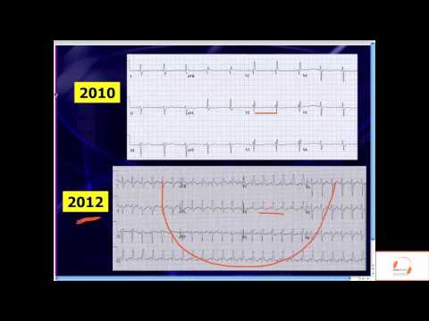 how to treat wide qrs complex