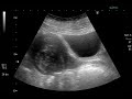 Myoma uteri Myoma uteri