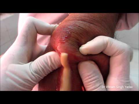 how to drain psoas abscess