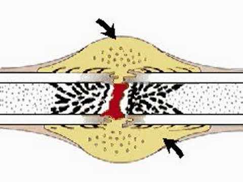 how to rebuild arteries