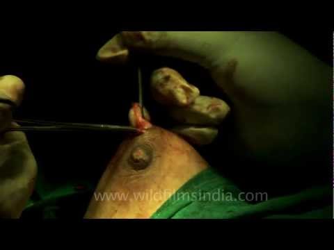 how to get rid breast cyst