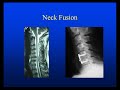 Neck or Arm Pain from Disc Herniation, Arthritis or Stenosis Neck or Arm Pain from Disc Herniation, Arthritis or Stenosis