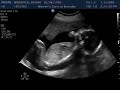 Ultrasound