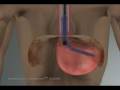 EsophyX™- Trans Oral Incision-less Fundoplication (TIF)