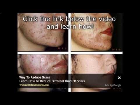 how to get rid of a pimple under the skin