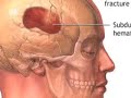 anatomy & physiology of skull fractures