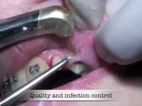 excisional biopsy lymph nodearmcpt code