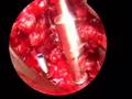 Podcast: Lumbar Laminectomy and Transforaminal Lumbar...