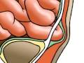 Malpractice Medical Hernia Repair Inguinal (Open) 1
