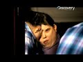 Human Mutations- Adult Conjoined Twins