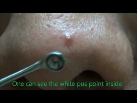 Acne Over Tip of Nose Ruptured