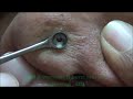 Acne Over Tip of Nose Ruptured