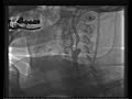 Carotid Stenting.mpg