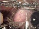 Eye jewel (JewelEyeTM) implantation Eye jewel (JewelEyeTM) implantation