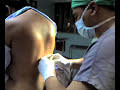 Anestesia Peridural