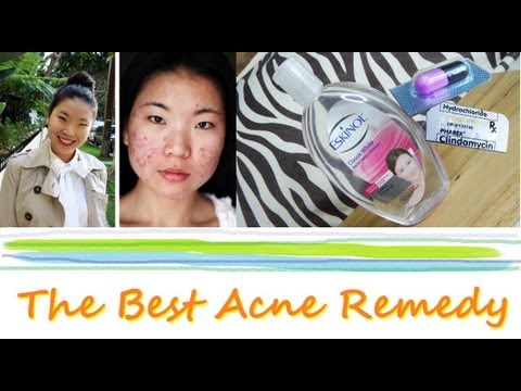 how to use dalacin c for acne