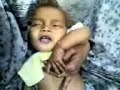 infantile tremor syndrome-3