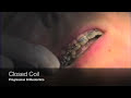 Closed Coil