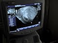 5-6 weeks Ultrasound