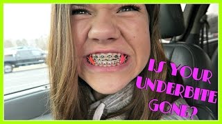 IS YOUR UNDERBITE GONE?