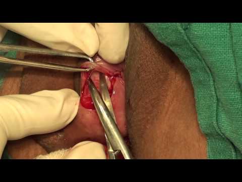 how to drain cyst on labia