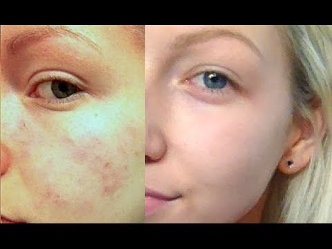How I Cleared My Skin! | Updated Skin Care Routine