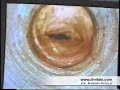 New York Plastic Surgery No Scar Breast Augmentation Video  Plastic and Cosmetic Surgery Scars