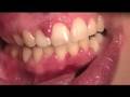 The Biolase Waterlase MD is used by Dr. Rosenberg to Remove Emily's Pyogenic Granuloma