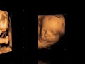 ECOGRAFIA 3D Y 4D DIAGNOSALUD ECOGRAFIA 3D Y 4D DIAGNOSALUD