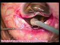 Planned intracapsular cataract extraction Planned intracapsular cataract extraction