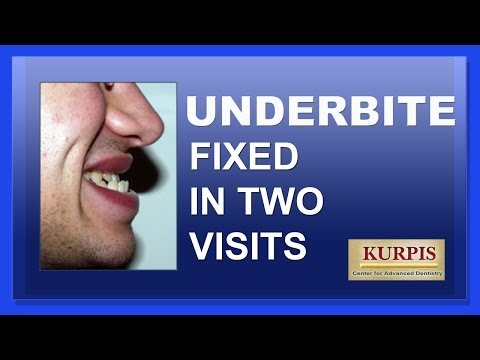 how to fix underbite
