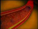 Metazoos Aterosclerosis
