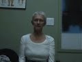 65 yo w/severe scoliosis, Spinecor Brace Testimonial