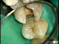Universal flowable restorative Dr. P. Colon - X Flow /1