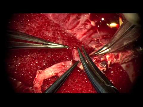 how to cure erectile dysfunction yahoo