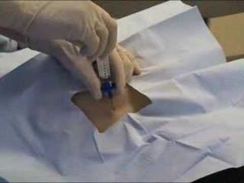 how to perform bone marrow biopsy