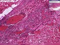 laparoscopy-appendicectomy-video-2-keyhole-lap-appendix.html