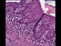 Histopathology Esophagus--Chronic esophagitis