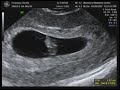 7 week 1 day ultrasound - cfree